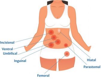 What is a Hernia? Alaska Hernia Center's Guide to Hernias