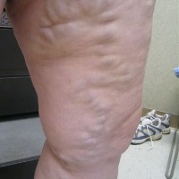 march-27,-2007-v-veins-002-79sguc