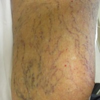 spider-veins_002-q6chp8